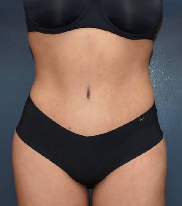 Abdominoplasty