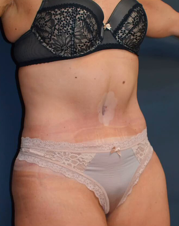 Abdominoplasty