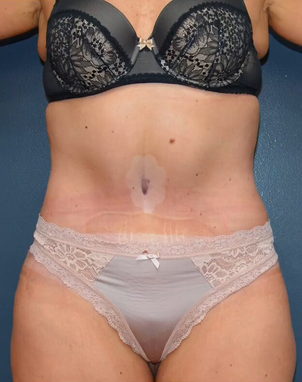 Abdominoplasty