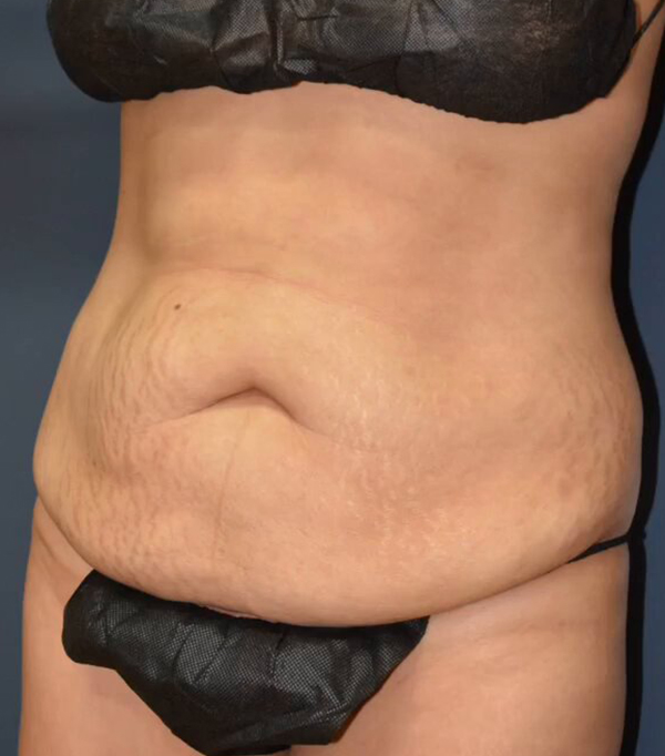 Abdominoplasty