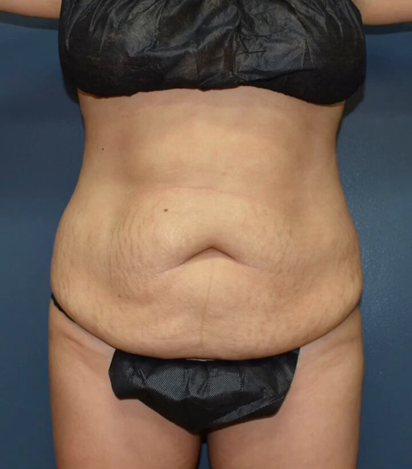 Abdominoplasty