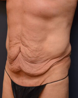 Abdominoplasty