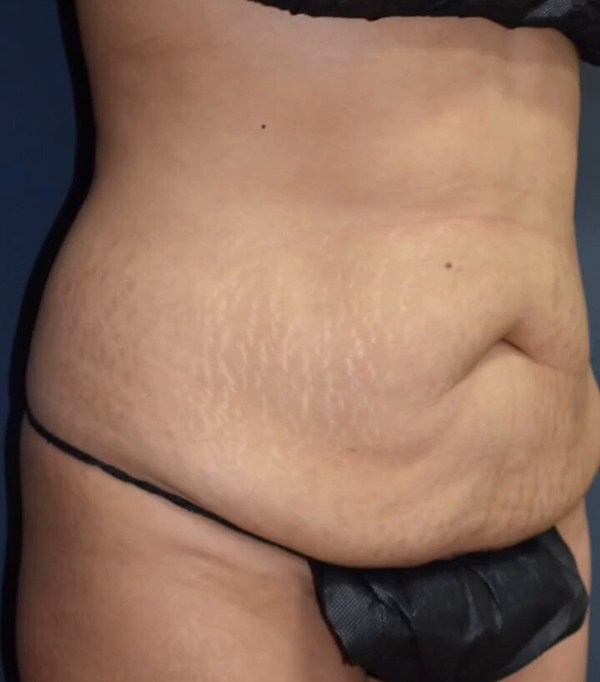 Abdominoplasty