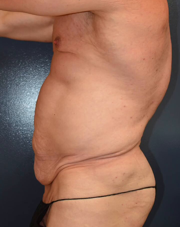 Abdominoplasty