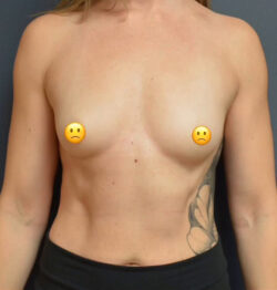 Breast Augmentation