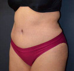 Abdominoplasty