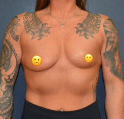 Breast Augmentation