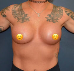 Breast Augmentation