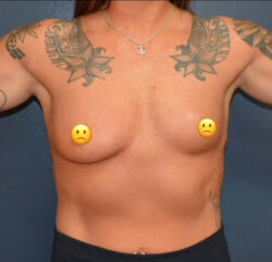 Breast Augmentation